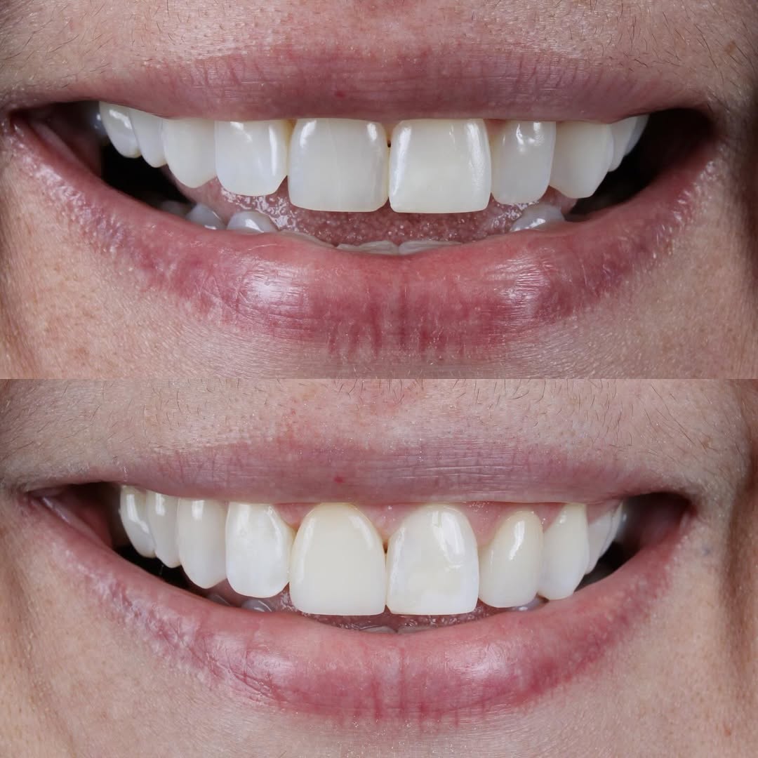 Antes e depois — caso 2